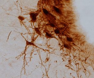 Identifican un mecanismo común en el cerebro entre el dolor diabético y la ansiedad Identifican un mecanismo común en el cerebro entre el dolor diabético y la ansiedad